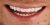 Veneer-07 After