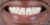 Veneer-08 Before