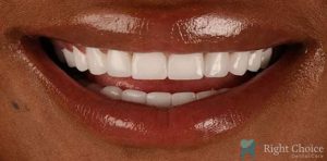 Veneer-10 After