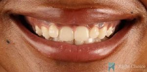 Veneer-10 Before