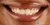 Veneer-10 Before