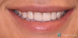 Veneer-11 After