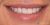 Veneer-11 After