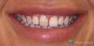 Veneer-11 Before