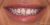 Veneer-11 Before