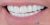 Veneer-12 After