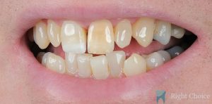Veneer-12 Before