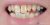 Veneer-12 Before