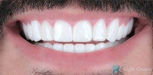 Veneer-13 After