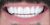 Veneer-13 After