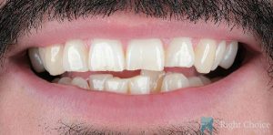 Veneer-13 Before