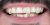 Veneer-13 Before