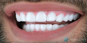 Veneer-14 After