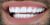 Veneer-14 After