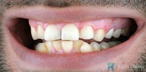Veneer-14 Before