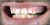 Veneer-14 Before