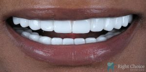 Veneer-15 After