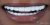 Veneer-15 After
