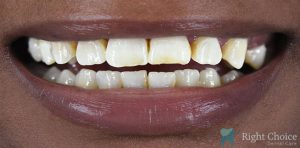 Veneer-15 Before
