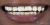 Veneer-15 Before