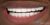 Veneer-16 After