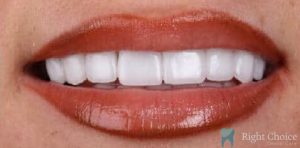 Veneer-17 After