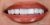 Veneer-17 After