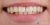 Veneer-17 Before