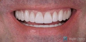 Veneer-18 After