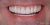Veneer-18 After