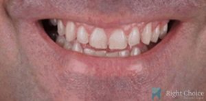 Veneer-18 Before