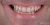 Veneer-18 Before