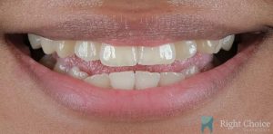 Smile Makeover-01 Before