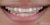 Smile Makeover-01 Before