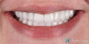 Smile Makeover-02 After