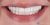 Smile Makeover-02 After