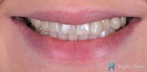 Smile Makeover-02 Before