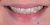 Smile Makeover-02 Before