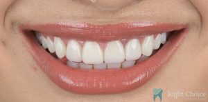 Smile Makeover-03 After
