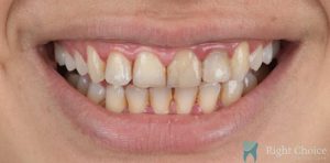 Smile Makeover-03 Before