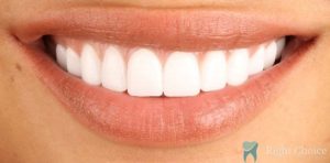 Smile Makeover-04 After