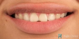 Smile Makeover-04 Before
