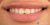 Smile Makeover-04 Before