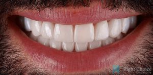 Smile Makeover-05 After