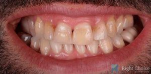 Smile Makeover-05 Before
