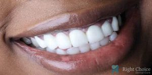 Smile Makeover-06 After