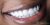 Smile Makeover-06 After