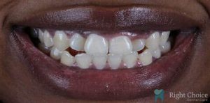 Smile Makeover-06 Before
