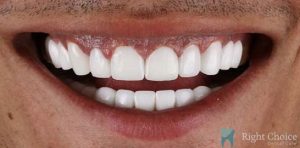 Smile Makeover-07 After