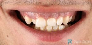 Smile Makeover-07 Before